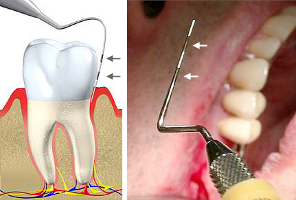Sonde zum Testen der Zahnfleischtaschen