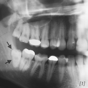 Röntgenbild Zahnsäckchen
